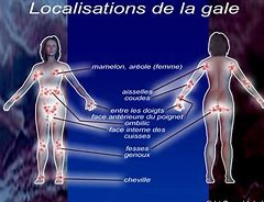 localistion eczéma gale